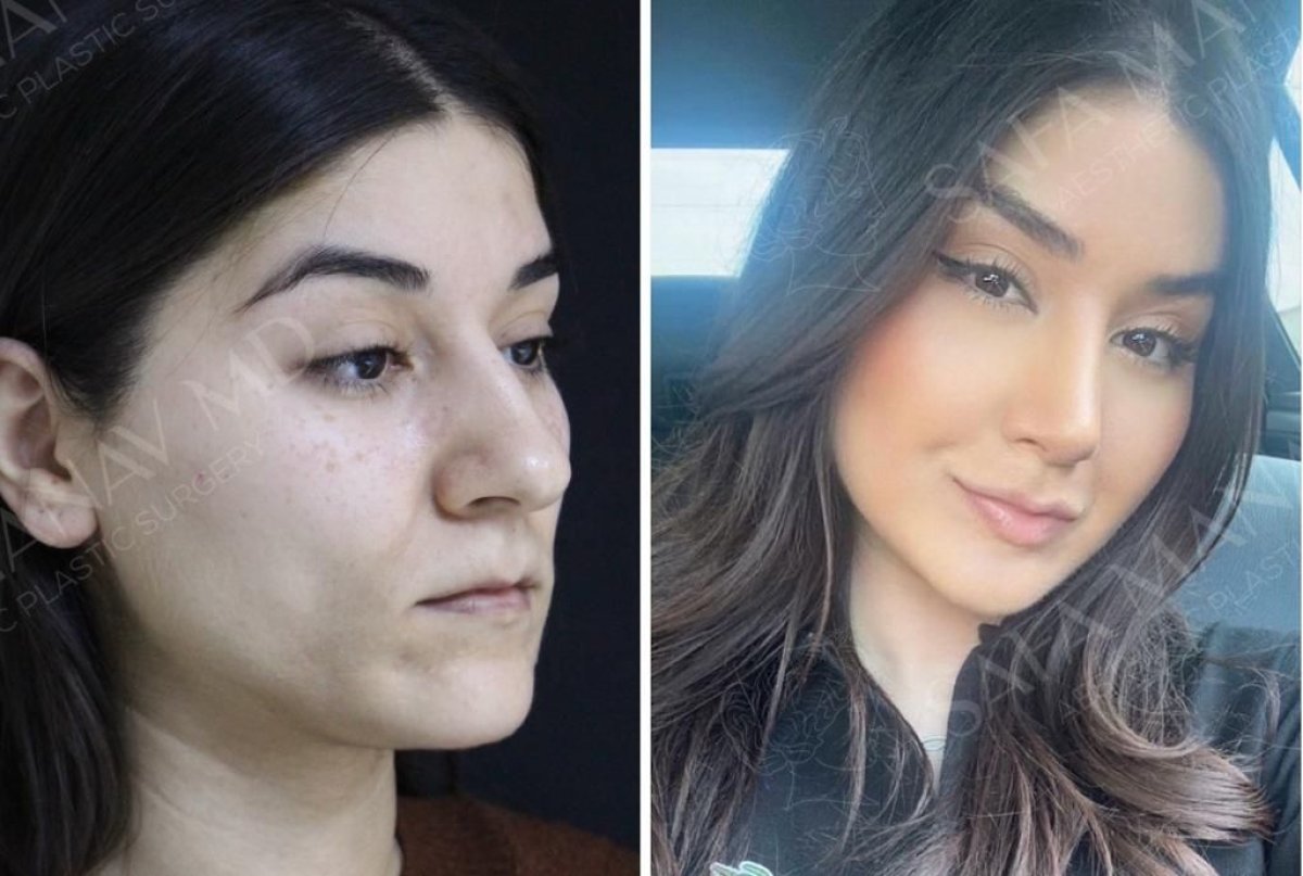 Resultados de minilifting facial antes y después en Dr. Safa Manav Clinic, rejuvenecimiento visible