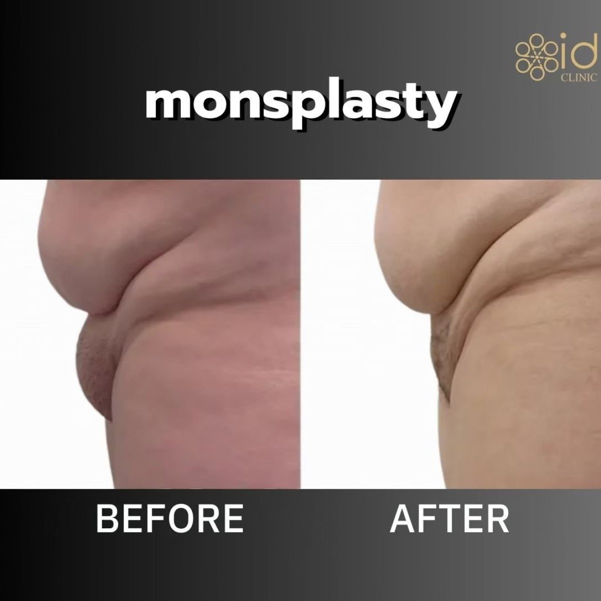 Before and after monsplasty results at ID Clinic Bangkok – reduced mons pubis bulge