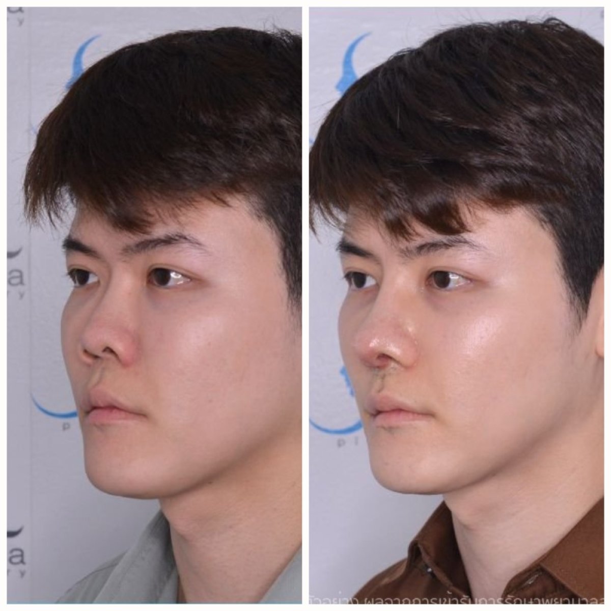 Before and after rhinoplasty results at Janasia Clinic, improved nose shape in male patient