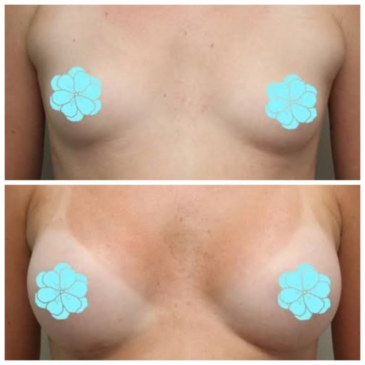 Before and after breast lift results at Wonjin Plastic Surgery Clinic, improved breast contour