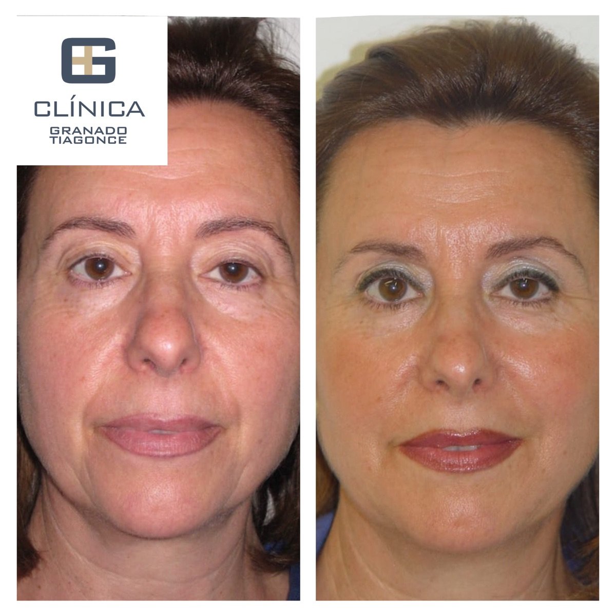 Resultados de lipofilling facial antes y después en Clinica Granado Tiagonce, mejora visible