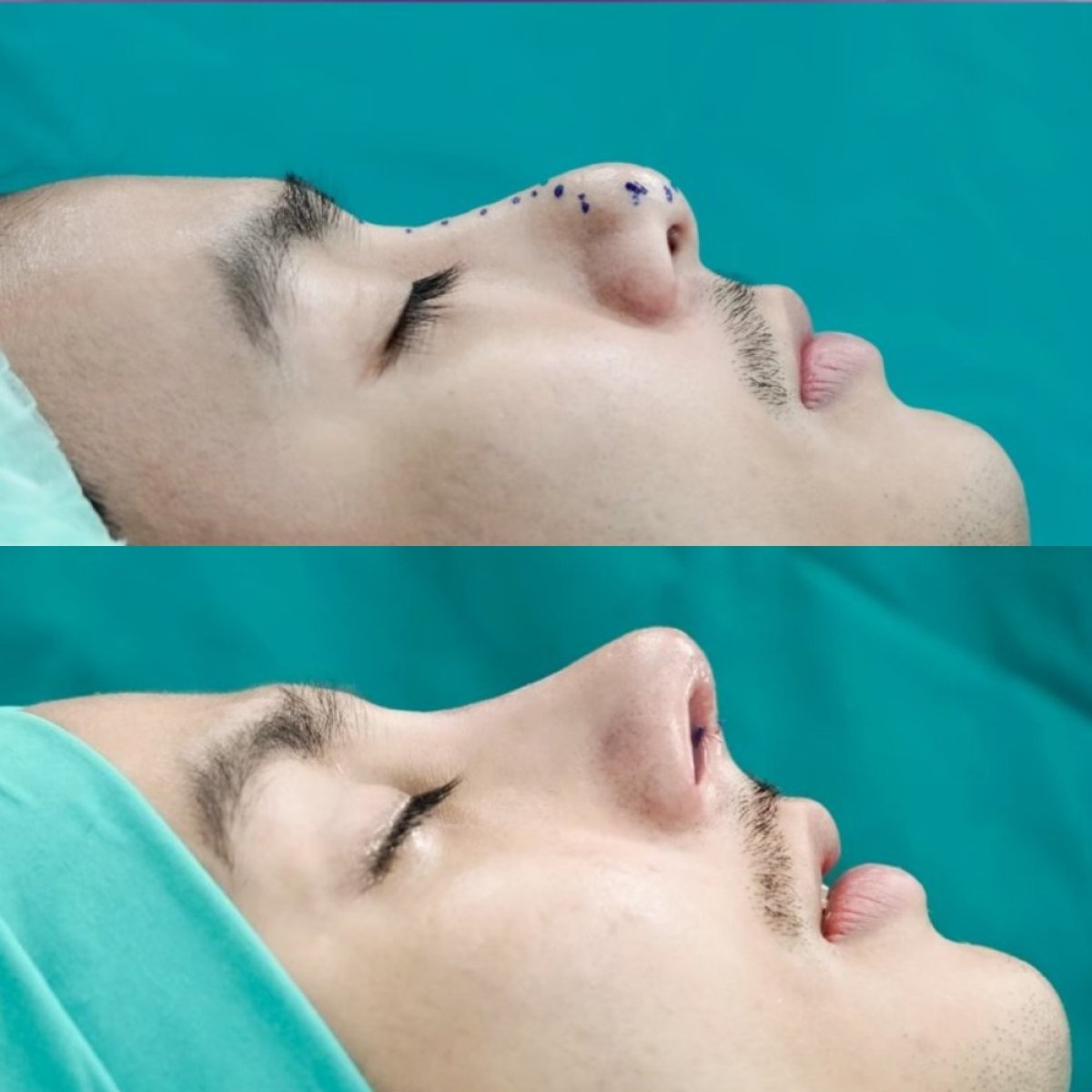 نتائج قبل وبعد عملية تجميل الأنف المفتوحة في The SiB Plastic Surgery، تحسين شكل الأنف