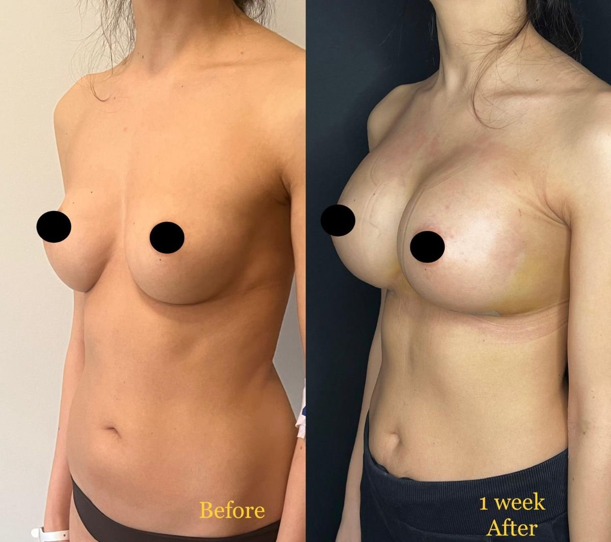 Resultados antes y después de revisión de implantes mamarios en Dr. Safa Manav Clinic, 1 semana