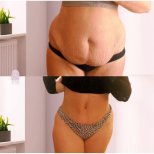 Before and after Liposuction photos by Dr. 