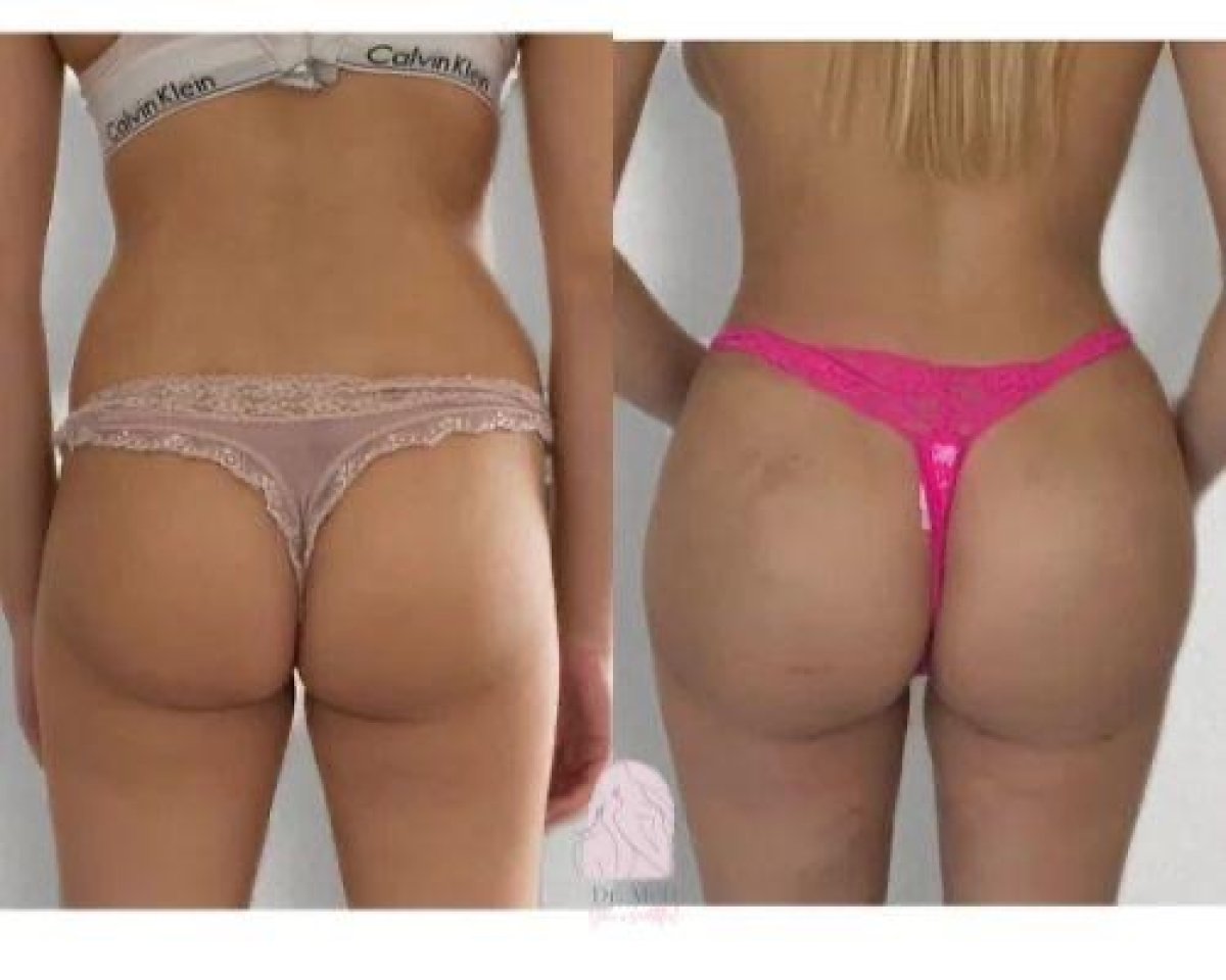 Antes y después de implantes de glúteos en Dr. MED – mayor contorno y volumen