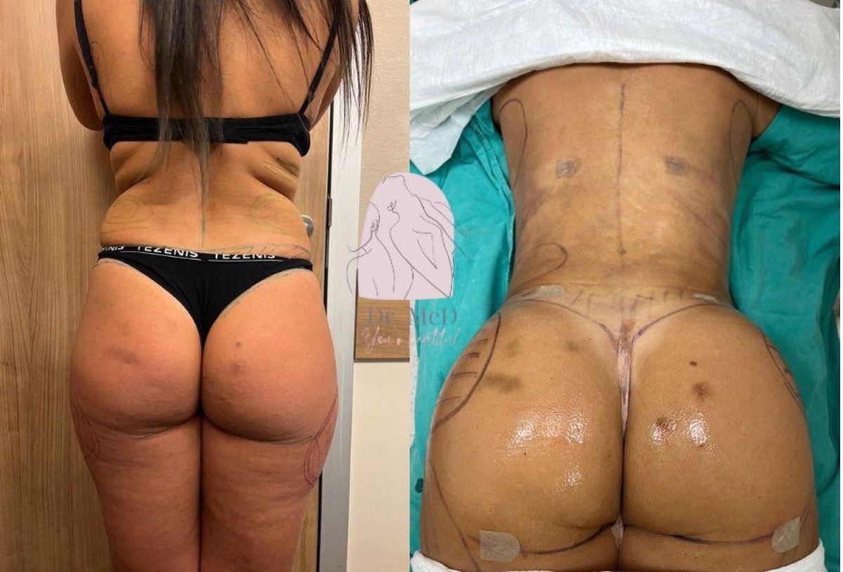 قبل وبعد زرع المؤخرة في Dr. MED – تحسين شكل وحجم الأرداف