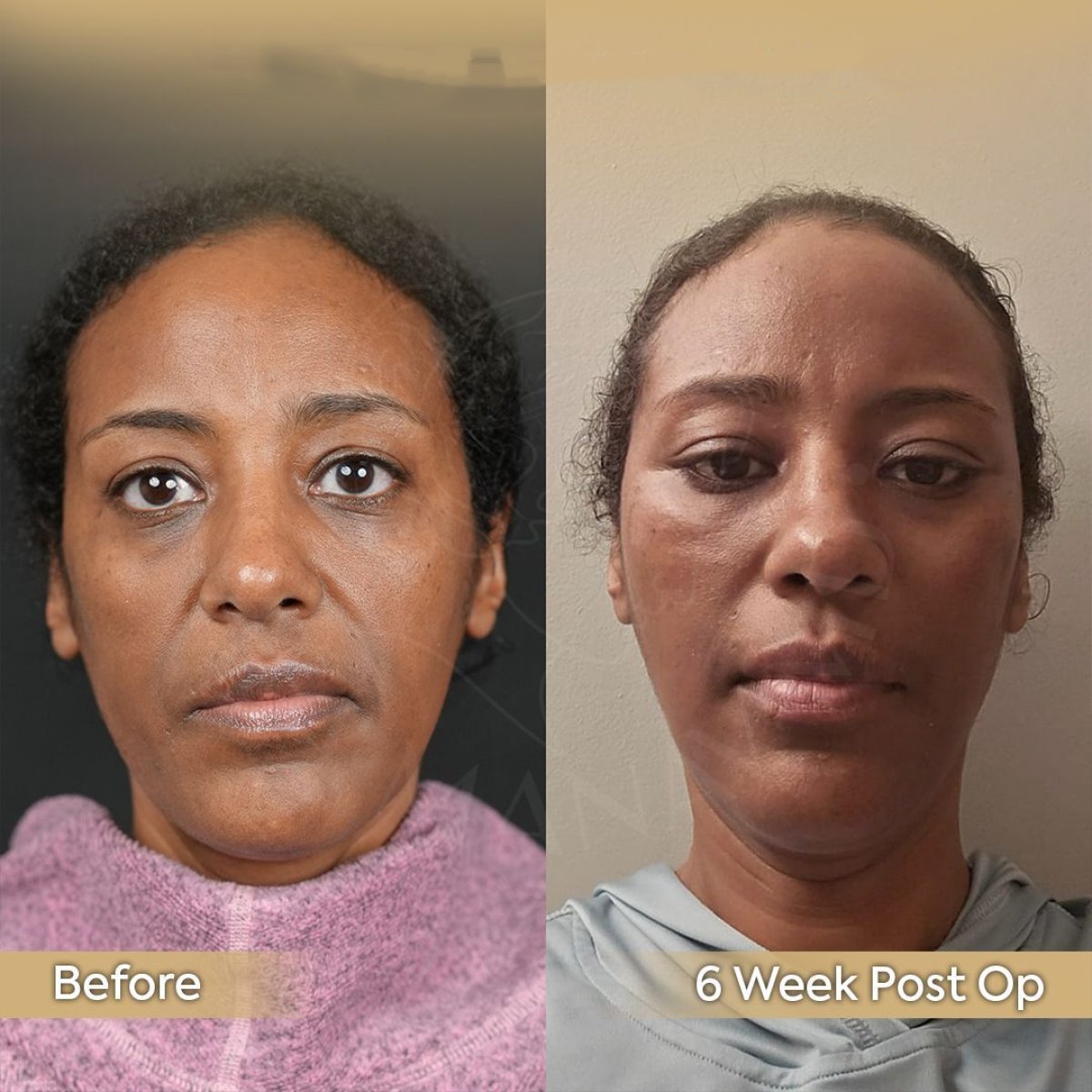 Resultados de minilifting facial antes y después en Dr. Safa Manav Clinic, rejuvenecimiento