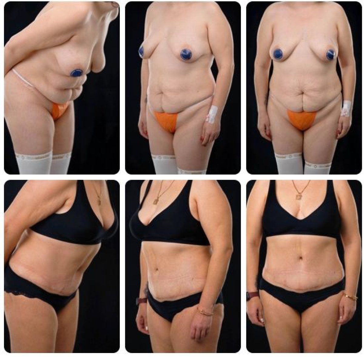 نتائج شد البطن قبل وبعد في Yurchenko Plastic Surgery Team Kyiv، تنسيق البطن