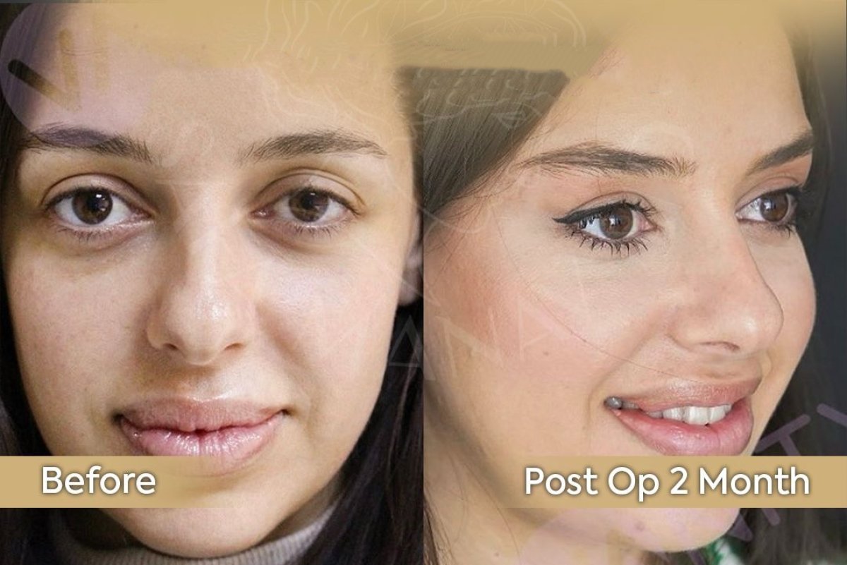 Mini facelift before and after results at Dr. Safa Manav Clinic, visible facial rejuvenation