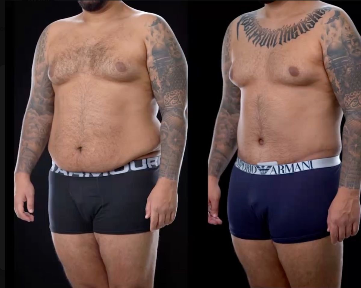 Before and after tummy tuck results at Yurchenko Plastic Surgery Team Kyiv, male body contour