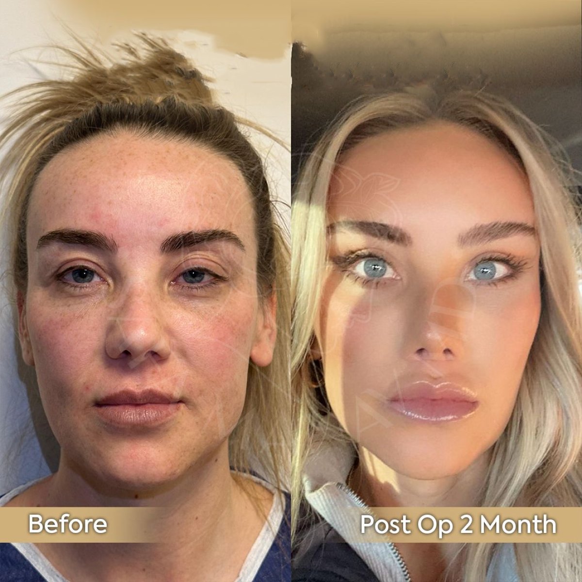 Resultados de minilifting facial antes y después en Dr. Safa Manav Clinic, rejuvenecimiento facial