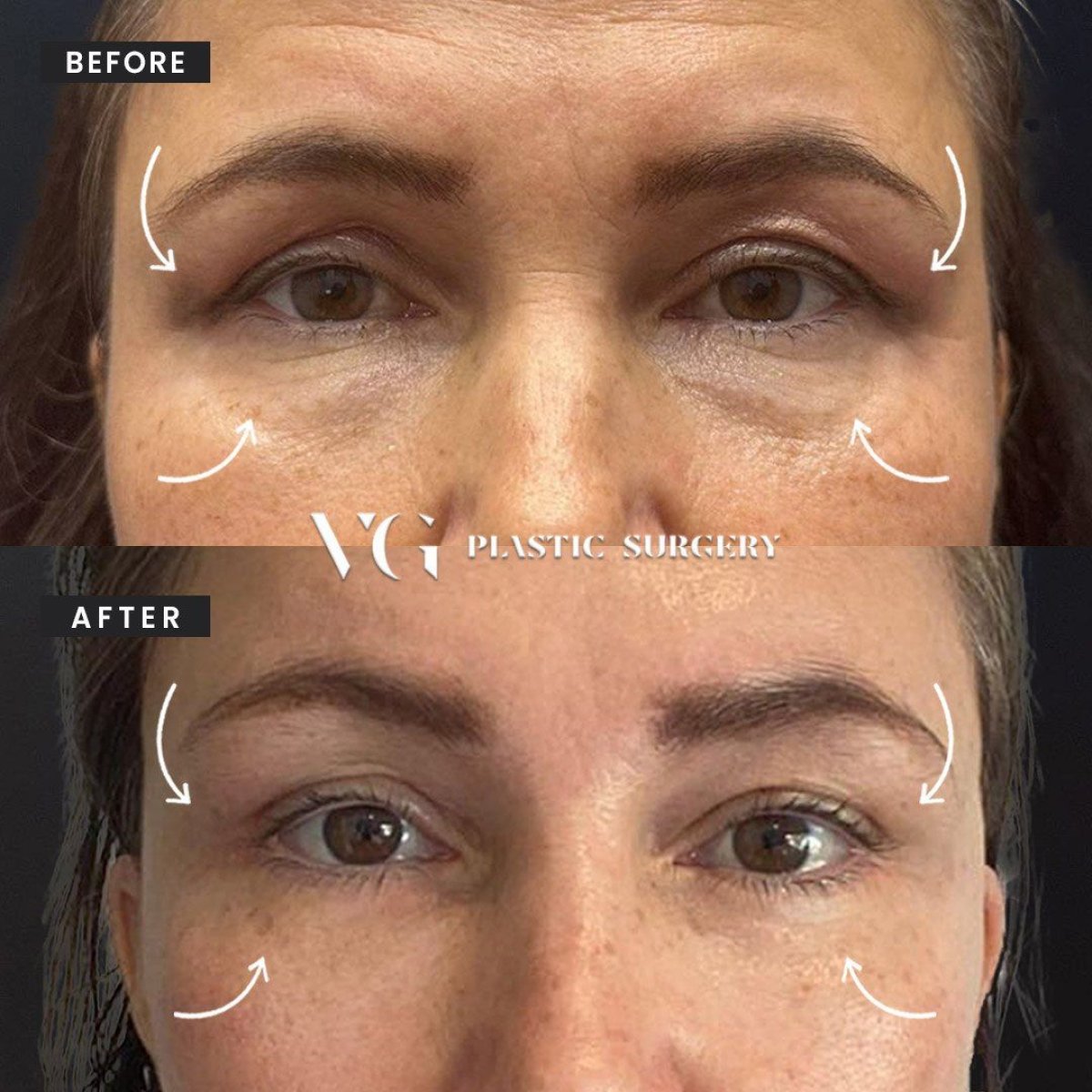 Resultados de blefaroplastia antes y después en VG Plastic Surgery, corrección de párpados