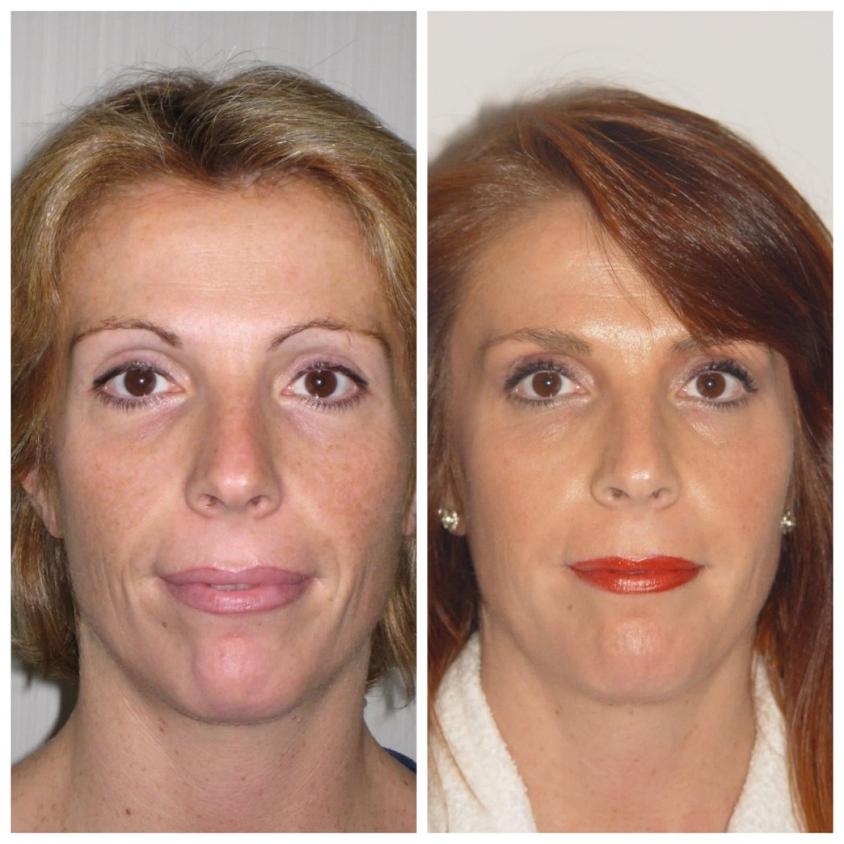 Resultados de lipofilling facial antes y después en Clinica Granado Tiagonce, mejora visible