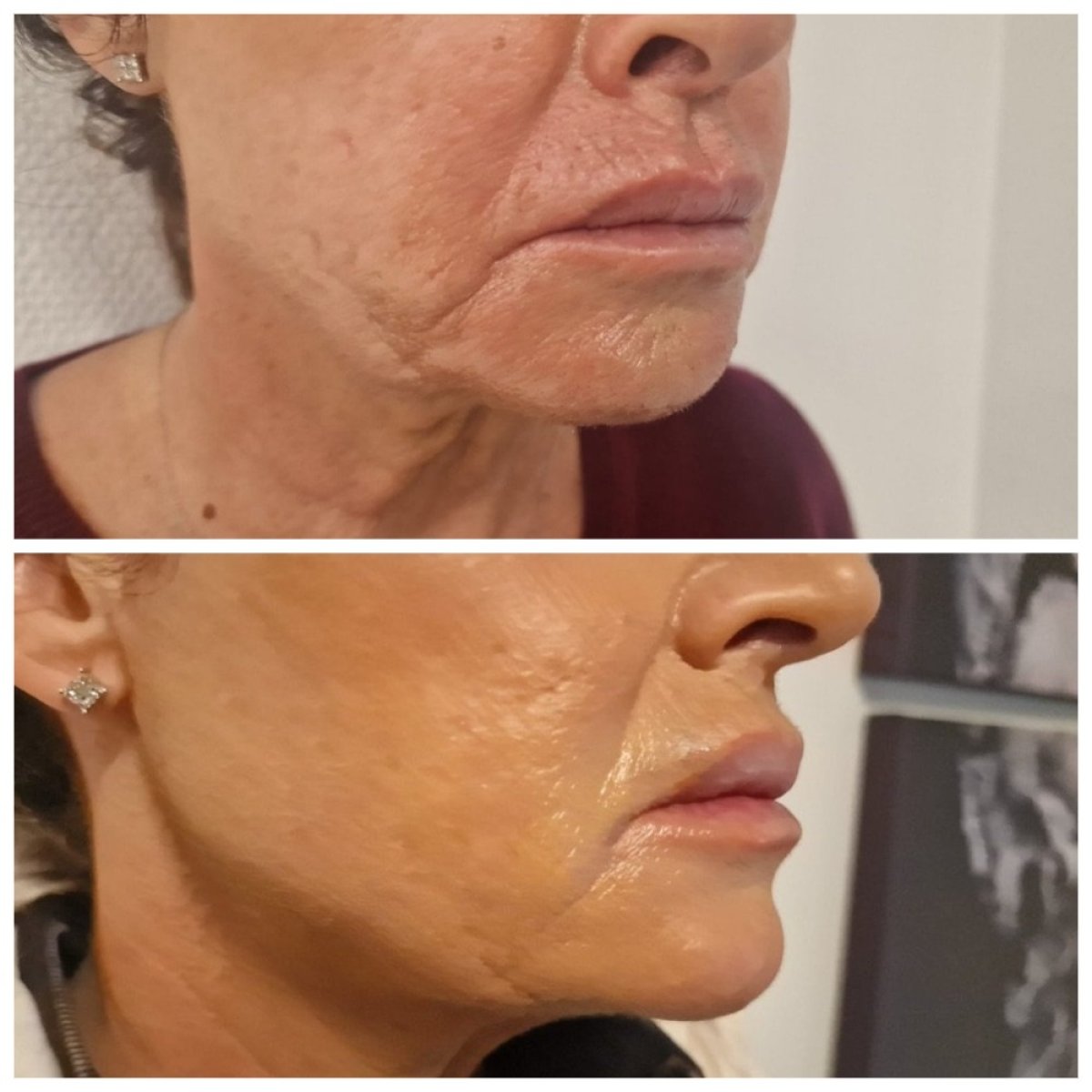 Antes y después de lipofilling en Clinica Granado Tiagonce, resultado de rejuvenecimiento facial