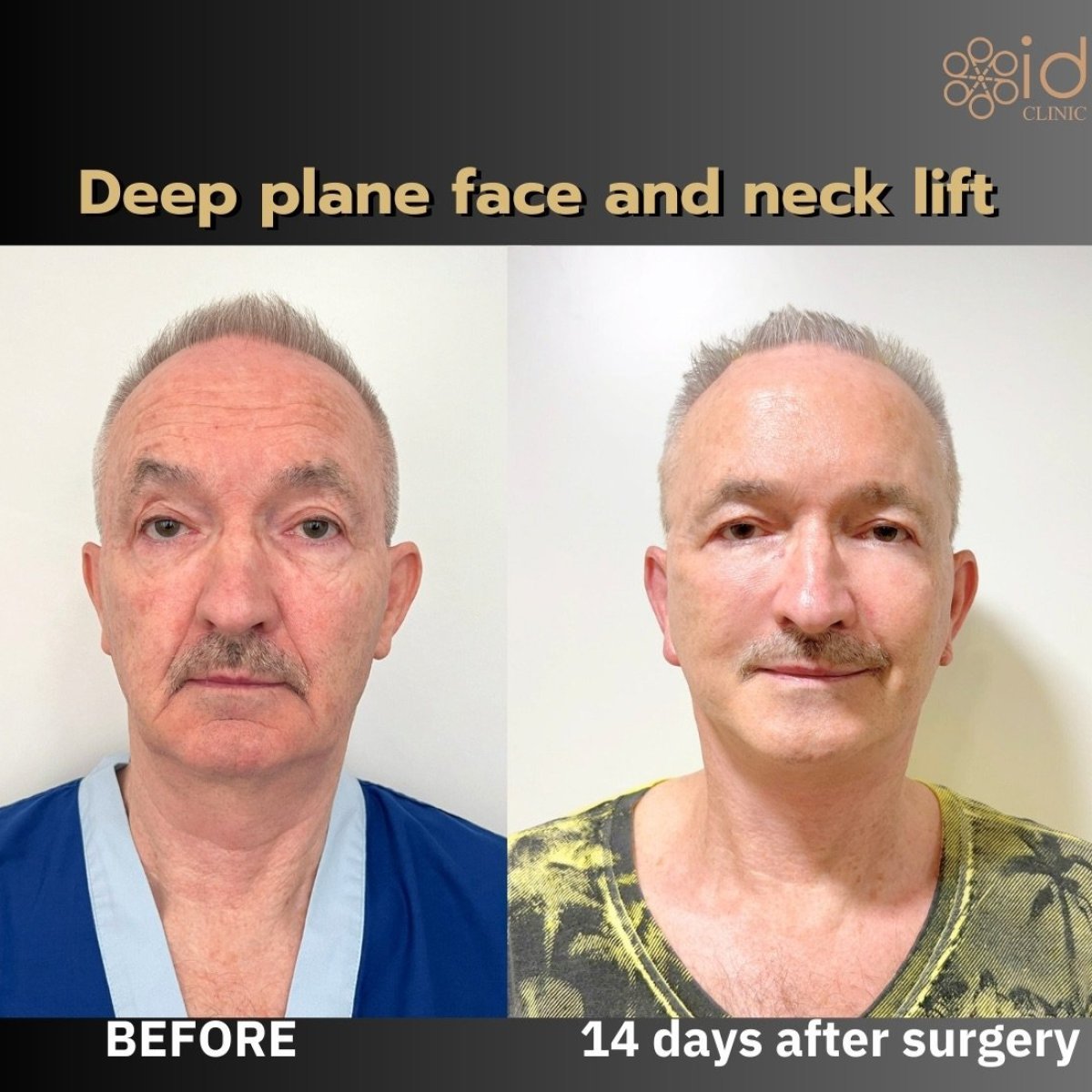 Before and after deep plane face and neck lift results at ID Clinic Bangkok, 14 days post-op