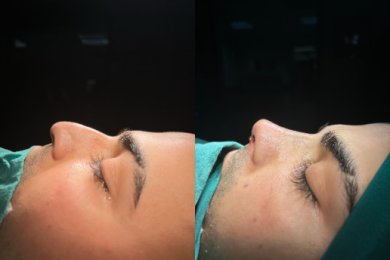Premium Rhinoplasty (nose job) with All Included - photo 3