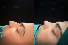 Фото до и после ринопластики кончика носа, доктор 