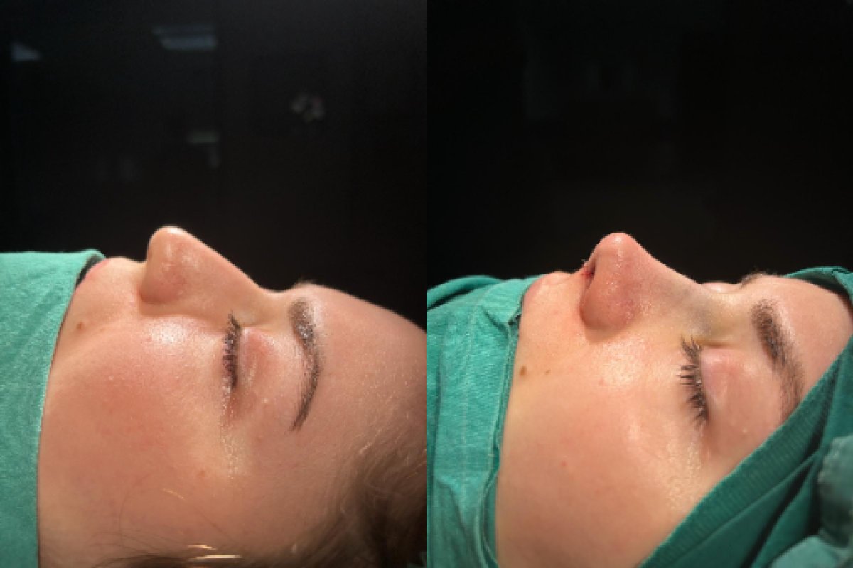 Resultados de rinoplastia antes y después en Atlas University Hospital, perfil nasal mejorado