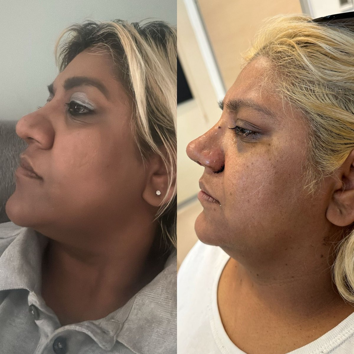 Resultados de rinoplastia antes y después en Atlas University Hospital, mejora de la nariz
