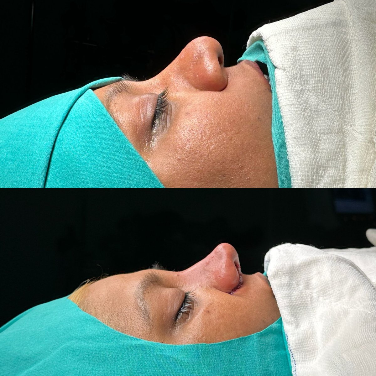 Resultados de rinoplastia antes y después en Atlas University Hospital, perfil nasal mejorado