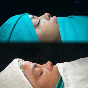 Premium Rhinoplasty (nose job) with All Included - photo 2