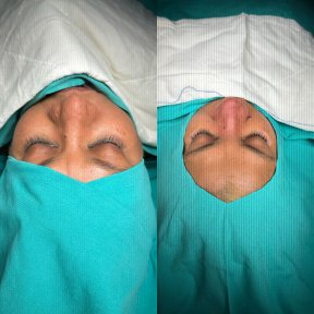 Premium Rhinoplasty (nose job) with All Included - photo 4