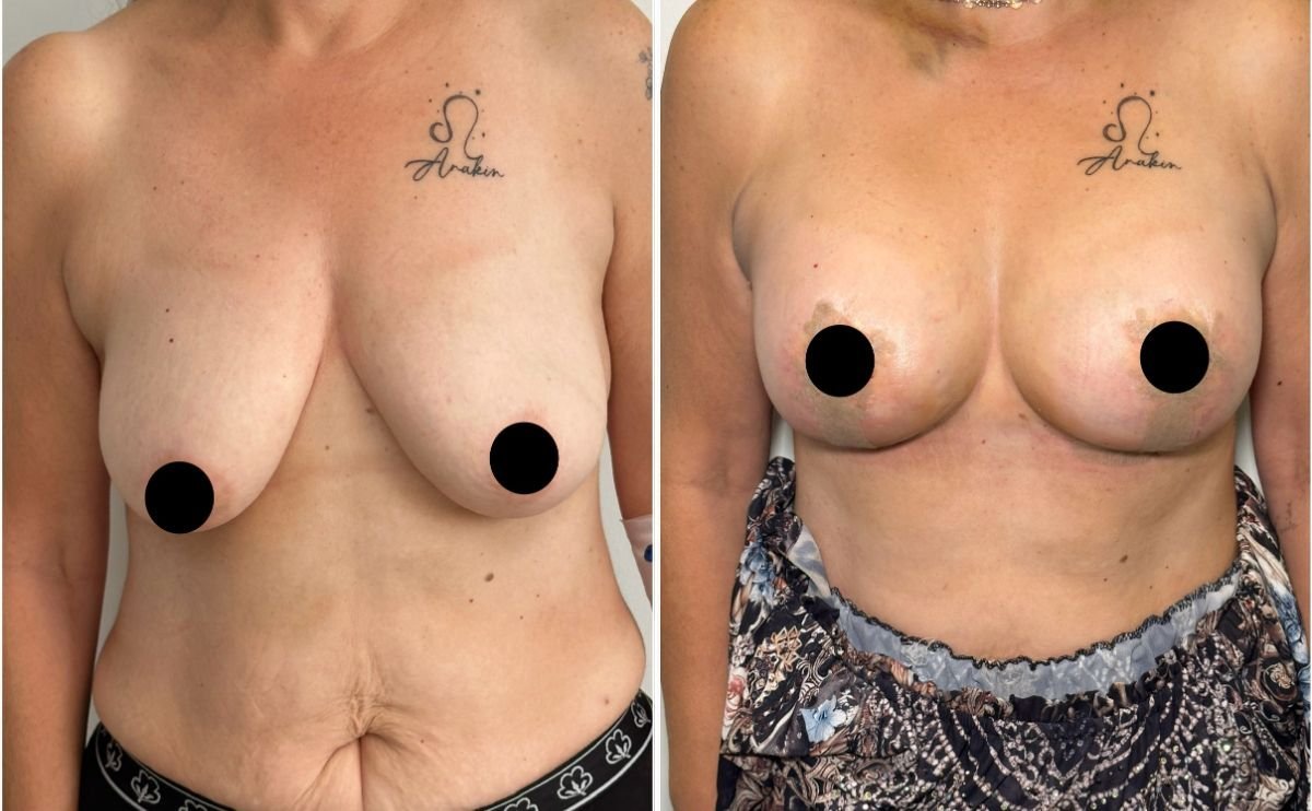 Avant/après implants mammaires avec lifting à la clinique Dr. Safa Manav, forme améliorée