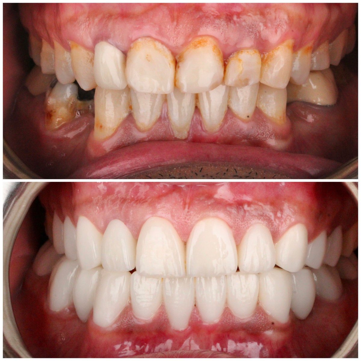 До и после установки циркониевых коронок в Dentlotus Clinic – результат преображения улыбки