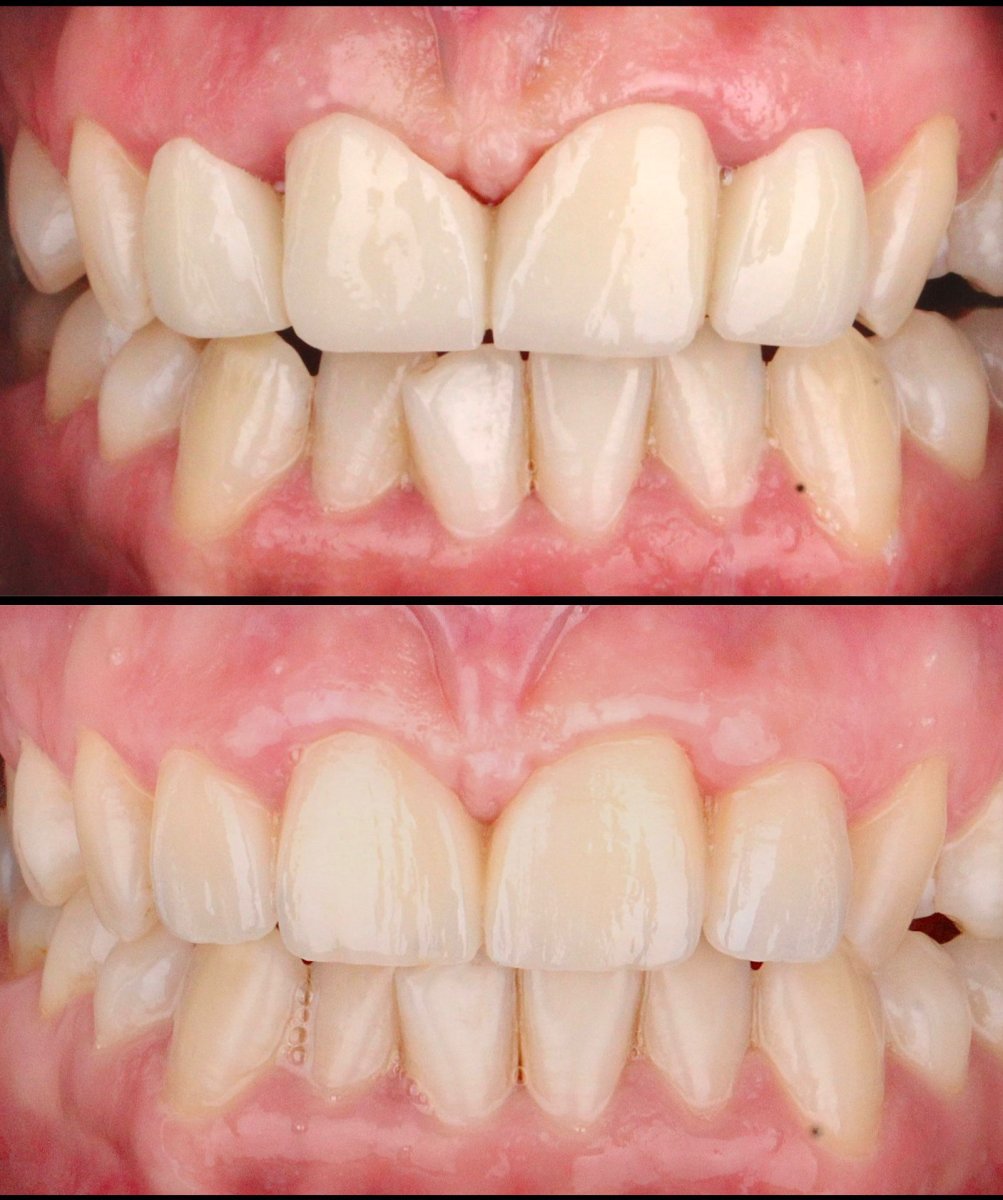 Before and after zirconia crown installation results at Dentlotus Clinic, improved smile