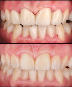 Get Your Hollywood Smile back with E-Max Veneers or CAD/CAM Full Porcelain with accommodation and transfer –only 2775 USD - photo 6