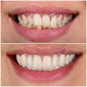 Get Your Hollywood Smile back with E-Max Veneers or CAD/CAM Full Porcelain with accommodation and transfer –only 2775 USD - photo 4