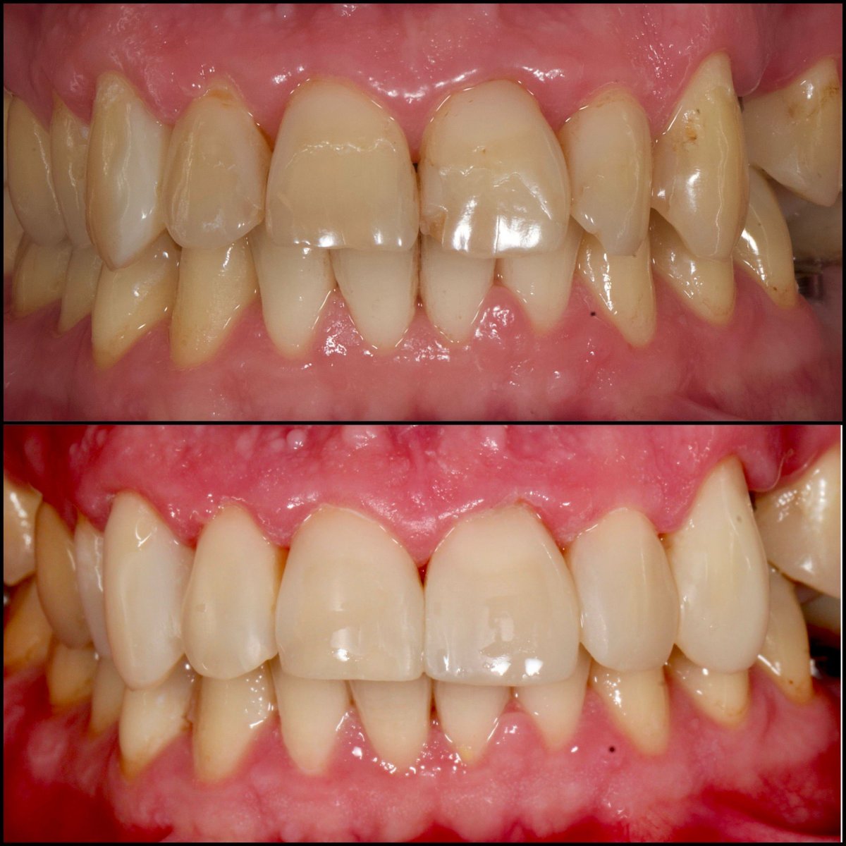 نتائج قبل وبعد ترابط الأسنان في Dentlotus Clinic – تحسين شكل ولون الأسنان
