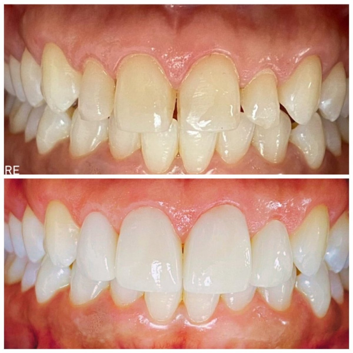 نتائج قبل وبعد تركيب تيجان الأسنان في Dentinno Dental Clinic، ابتسامة محسنة