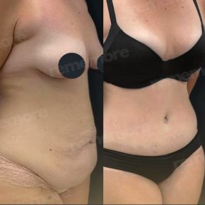 360 Liposuction - photo 4