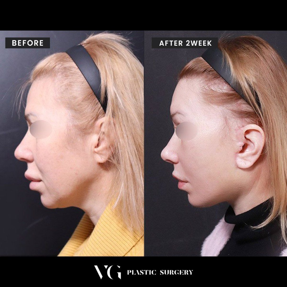 Результаты до и после подтяжки шеи в VG Plastic Surgery – улучшен контур шеи и челюсти