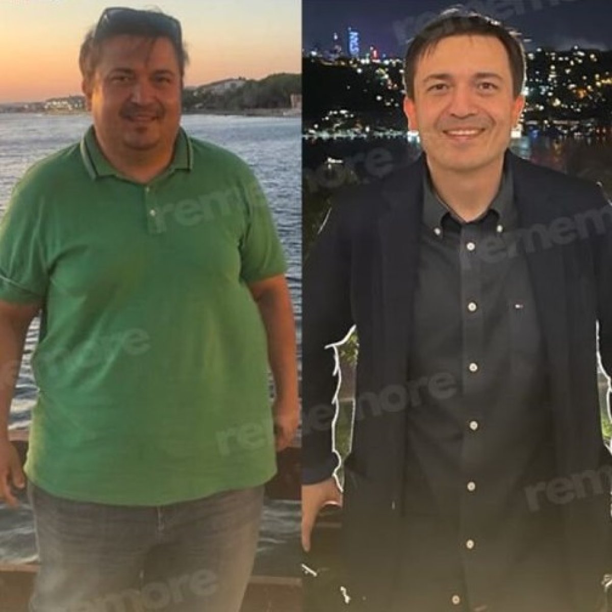 Résultats avant et après ballon gastrique à Memorial Antalya Hospital – perte de poids visible