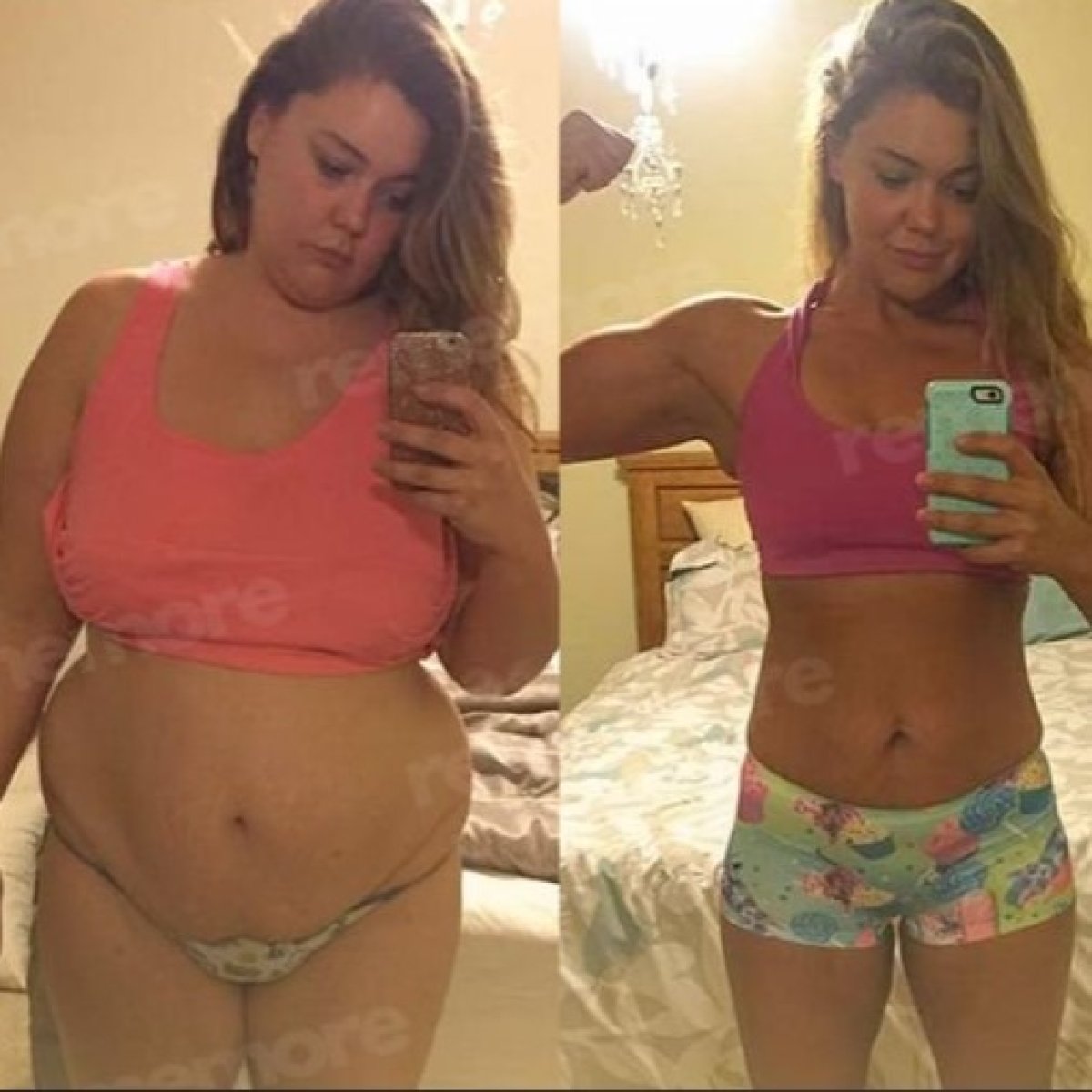 Before and after gastric balloon results at Memorial Antalya Hospital, visible weight loss achieved