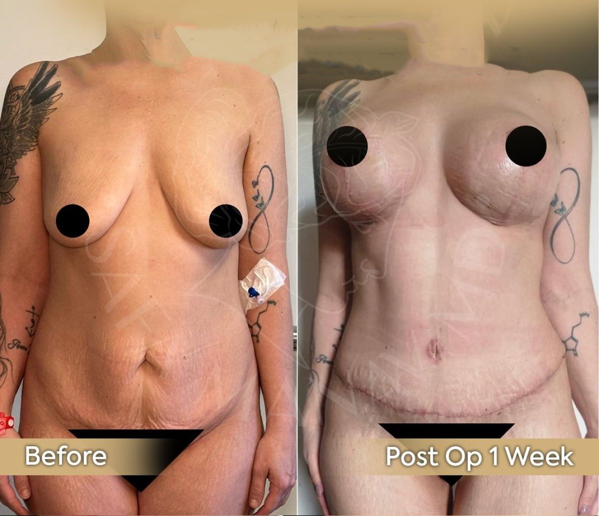 Résultats avant/après abdominoplastie à la clinique Dr. Safa Manav, amélioration du ventre