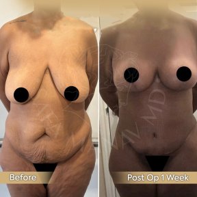 Premium Tummy Tuck Surgery-All Incluisive with European Board Certified Doctor Ali Sadioglu - photo 4
