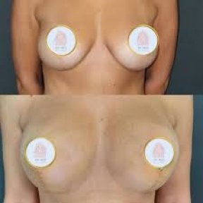 Standard Breast lift All Included - photo 4