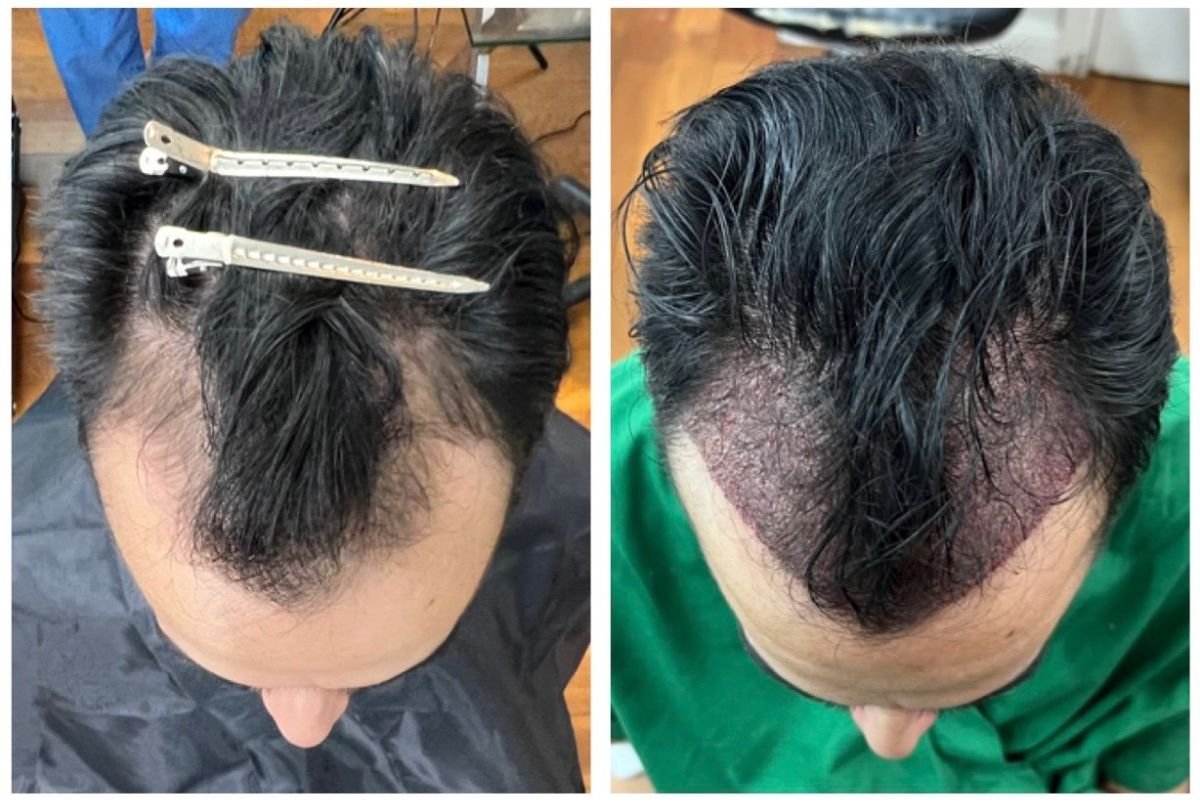 Resultados de trasplante capilar antes y después en He Clinic Bangkok, restauración capilar
