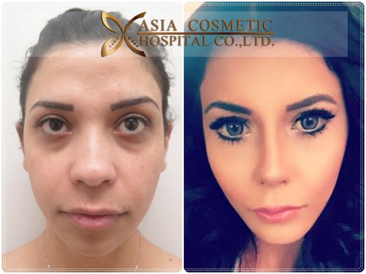 Before and after tip rhinoplasty results at Asia Cosmetic Hospital, refined nose shape visible