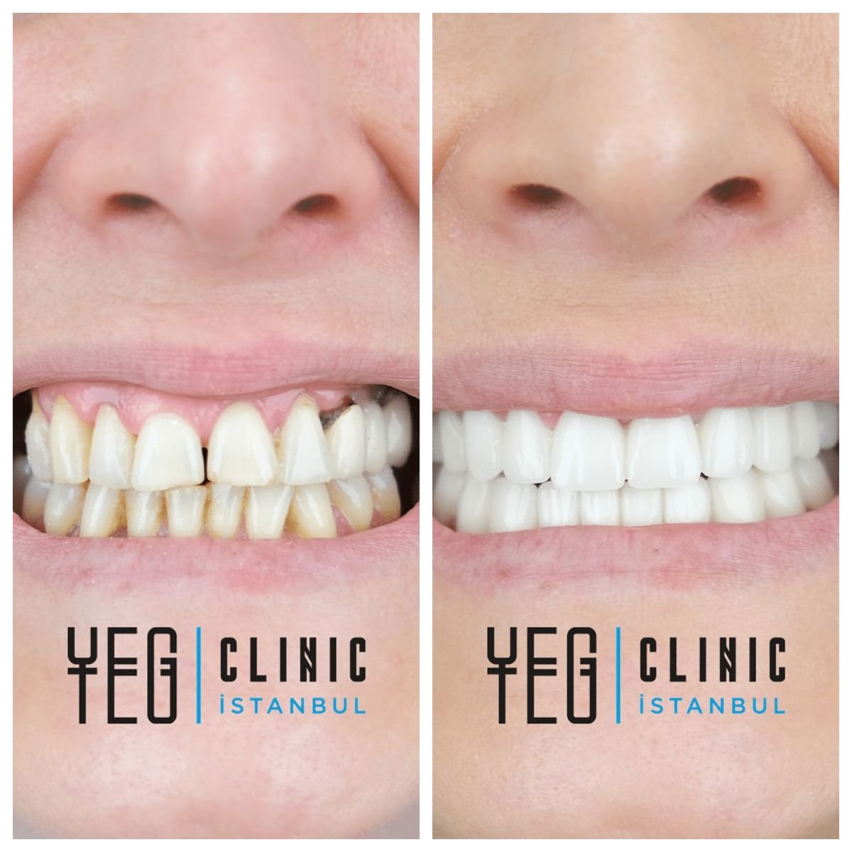 Porcelain veneer before and after results at YEG Clinic – smile transformation and whiter teeth