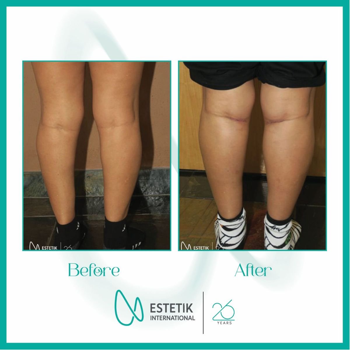 Antes y después de implantes de pantorrilla en Estetik International Istanbul, mejor contorno