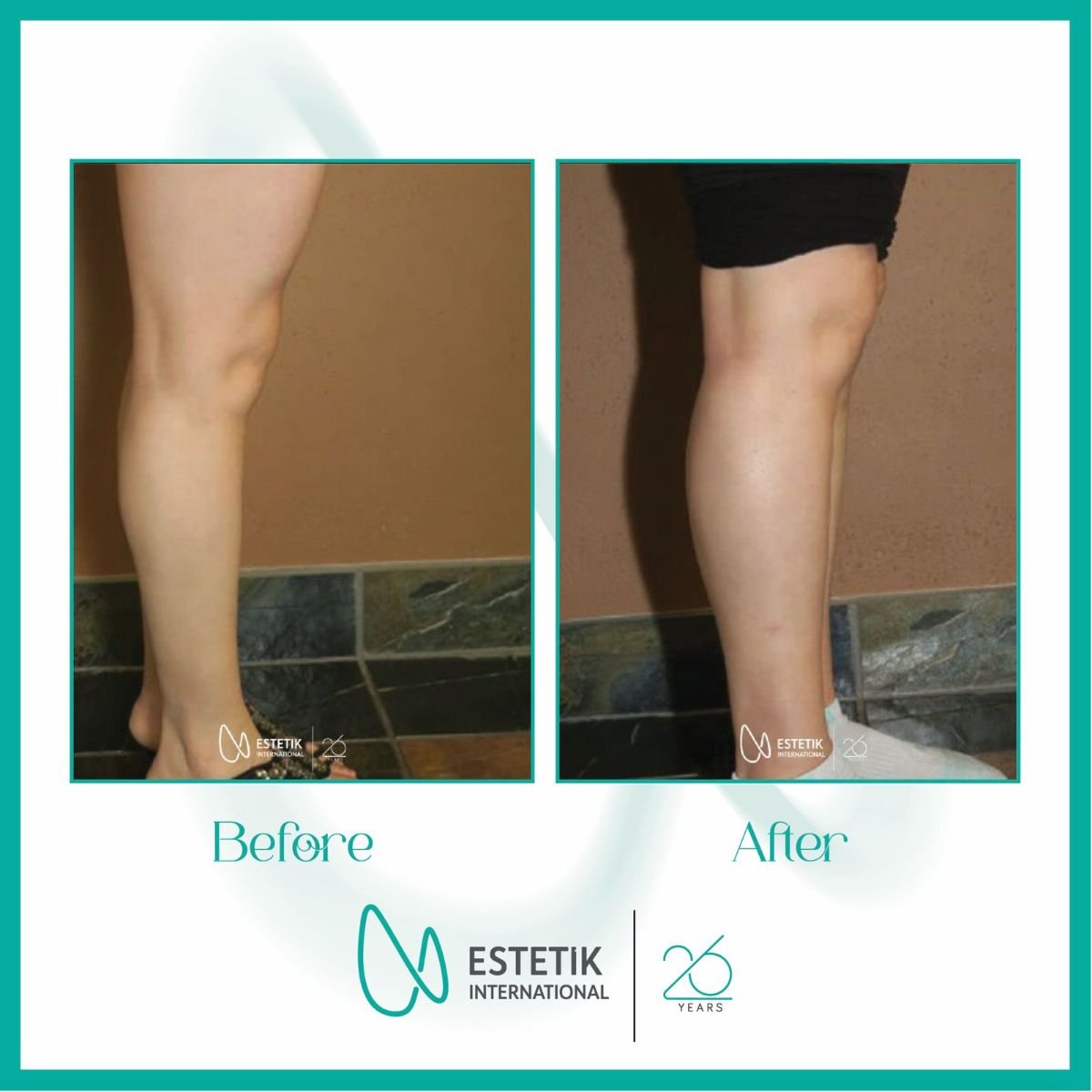 Antes y después de implantes de pantorrilla en Estetik International Istanbul, mejora visible
