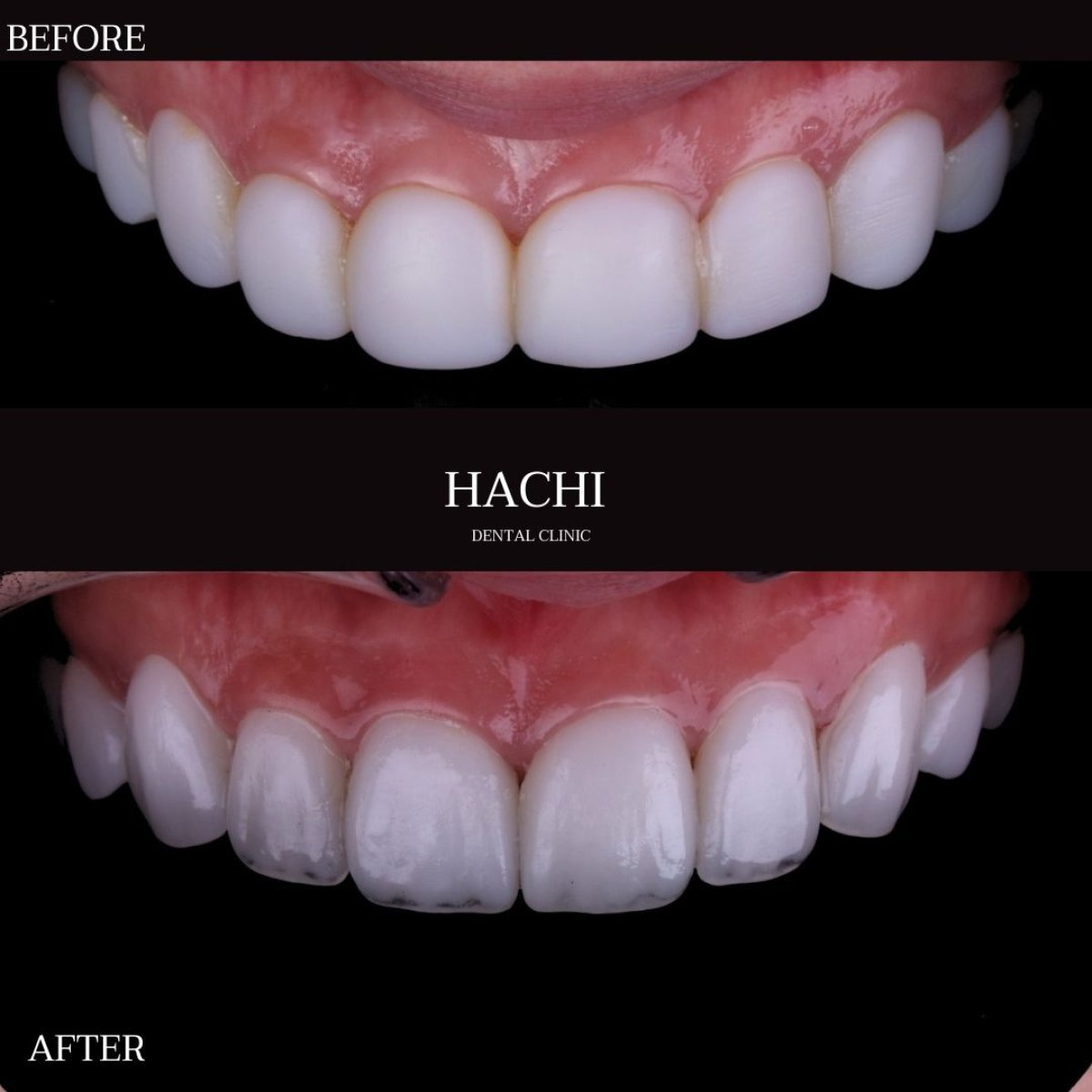 نتائج قبل وبعد قشور البورسلين في Hachi Dental Clinic & Digital Veneer Lab