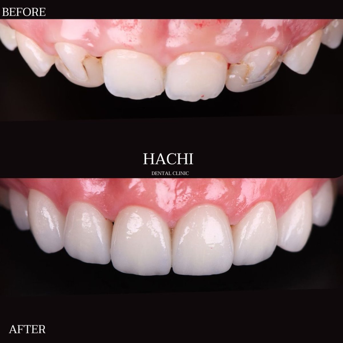 Resultados de carillas de porcelana antes y después en Hachi Dental Clinic & Digital Veneer Lab