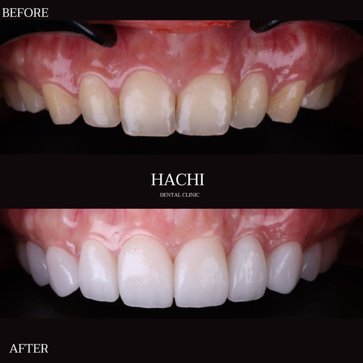Résultats avant/après facettes en porcelaine à Hachi Dental Clinic & Digital Veneer Lab, sourire transformé
