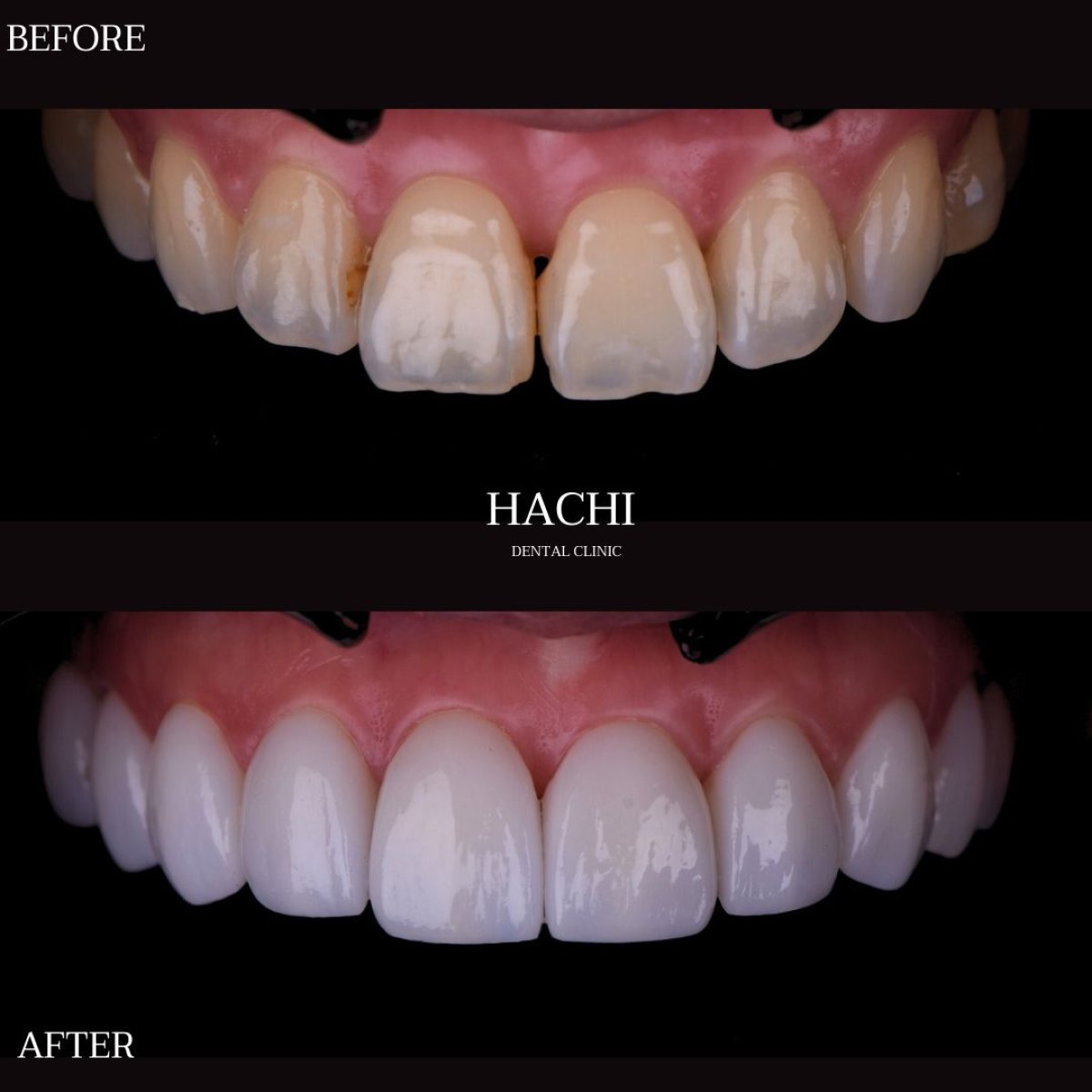 Resultados antes y después de carillas de porcelana en Hachi Dental Clinic & Digital Veneer Lab