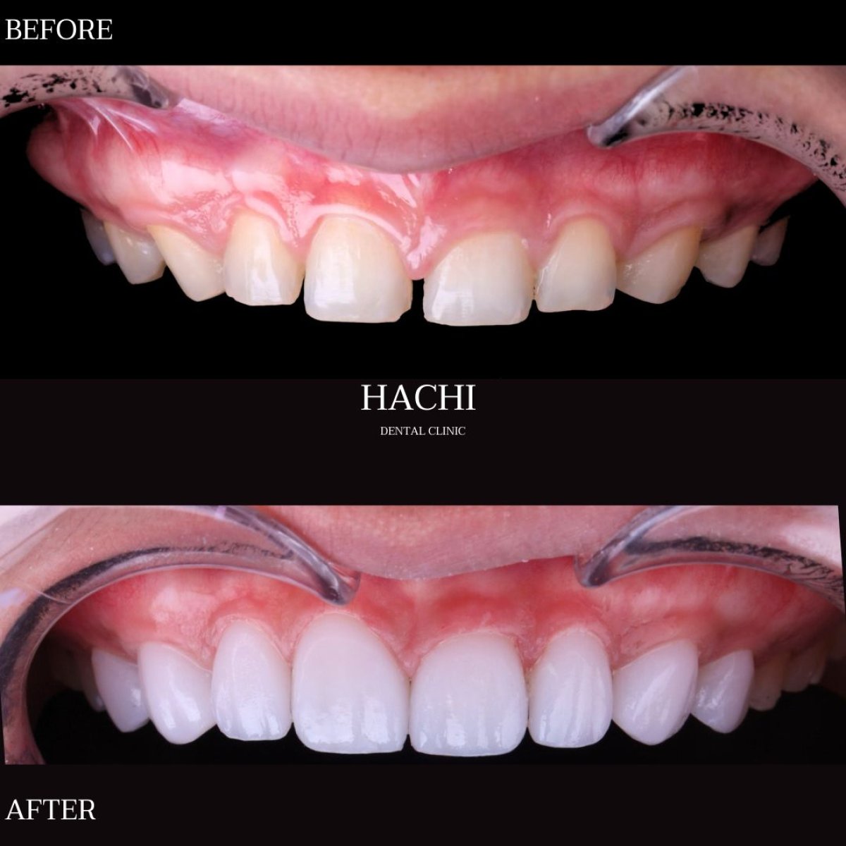 Результати до і після встановлення порцелянових вініров у Hachi Dental Clinic & Digital Veneer Lab
